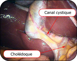 Canal cystique et cholédoque