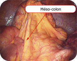 Méso-colon