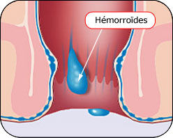 Hémorroïdes Hémorroïdes