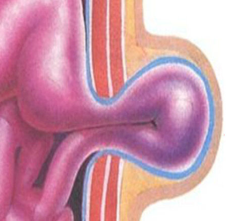 Piégeage intestinal - Hernie inguinale et de l'aine Piégeage intestinal - Hernie inguinale et de l'aine