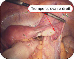 Trompe et ovaire droit Trompe et ovaire droit