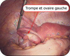 Trompe et ovaire gauche Trompe et ovaire gauche